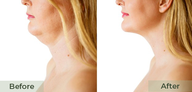 Before and after chin fat reduction showing improved jawline.
